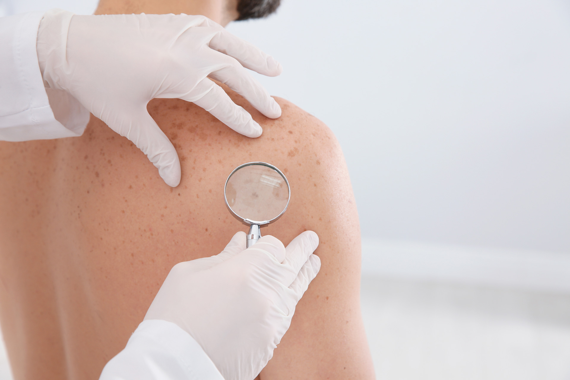 Man's skin and back being examined by a doctor for potential issues before receiving a skin treatment and learning about men's health services at Men's Only Medical in West Palm Beach and Palm Beach.