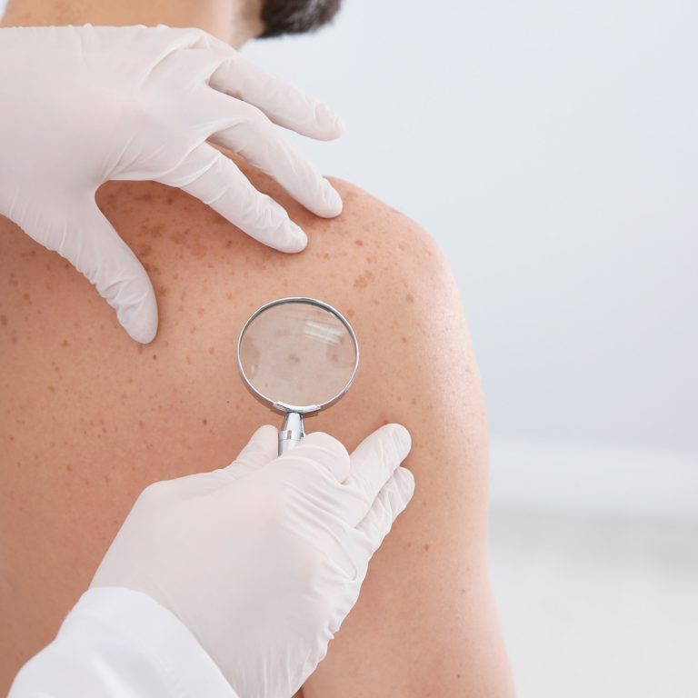 Man's skin and back being examined by a doctor for potential issues before receiving a skin treatment and learning about men's health services at Men's Only Medical in West Palm Beach and Palm Beach.